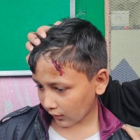 भारतीयले हानेको ढुङगा लागेर नेपाली बालक घाईते ।
